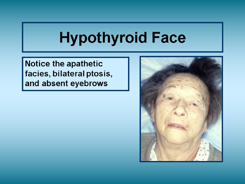 Hypothyroid Face Notice the apathetic facies, bilateral ptosis, and absent eyebrows